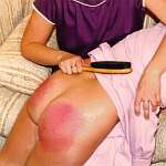 Painful reddened buttocks from the wooden brush beating